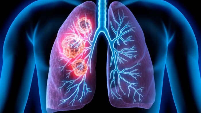 No matter how a person gets lung cancer, it should not impact the care they get or the empathy they receive.