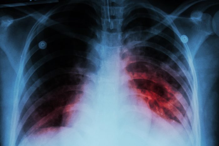 TB is endemic to Malaysia.